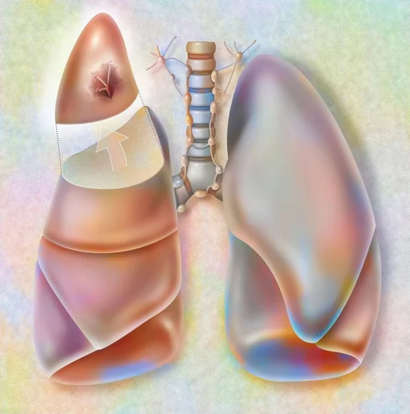 Removal Apical Segment Right Lung Affected Cancerous Tumor — 图库照片