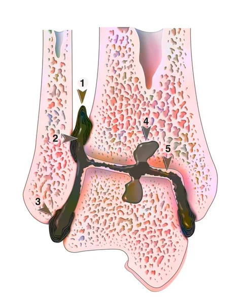 Hemophilic Arthropathy Ankle Frontal Cut — Stockfoto