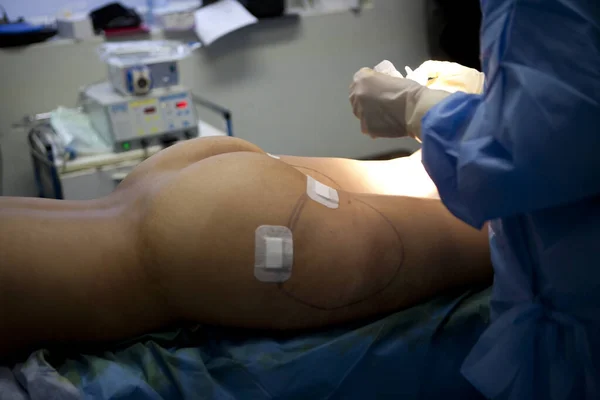 Cosmetic Surgery Liposuction Aspiration Fat Pump — Stockfoto