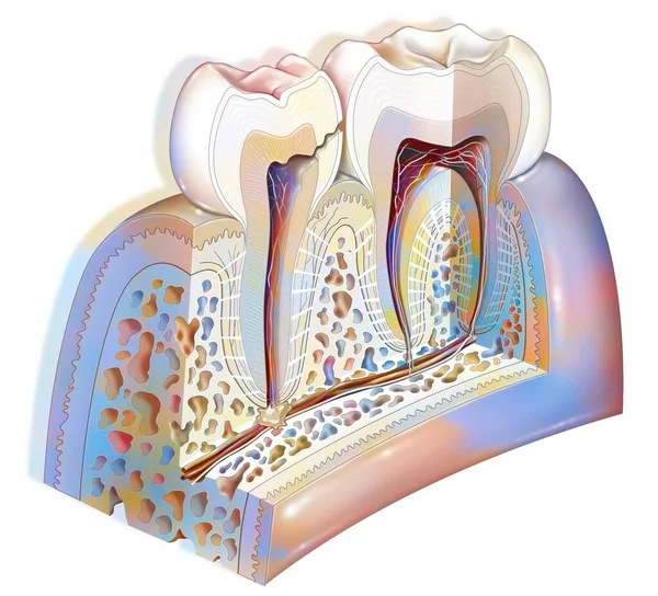 Dental Plaque Third Stage Tooth Decay Damage Dental Pulp — 스톡 사진