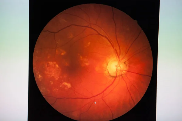 Fundus Routine Examination Established Ophthalmoscope Check Health Eye —  Fotos de Stock