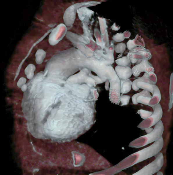 Arterial Canal Carries Blood Pulmonary Artery Aorta Fetal Life Normally — Photo