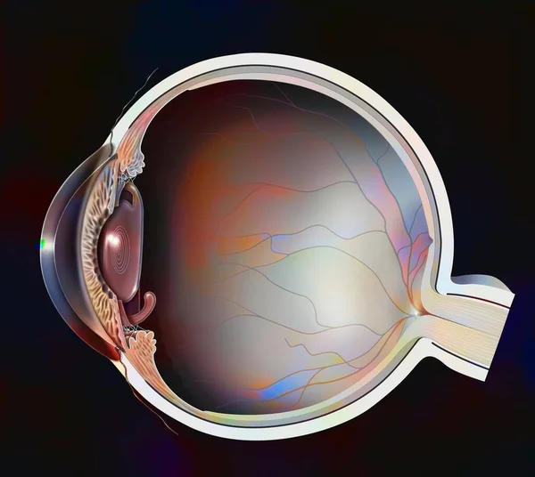 Глаз Пресбиопия Мультифокальный Имплантат Замены Хрусталика — стоковое фото