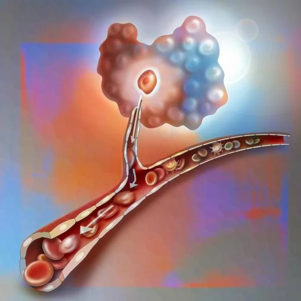 Spread Metastases Body Tumor Triggering Angiogenesis — Stockfoto