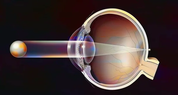 Hyperopic Eye Formation Image Retina — Foto Stock