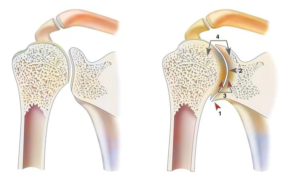 Healthy Ankle Hemophilic Arthropathy Frontal Cut — Foto Stock