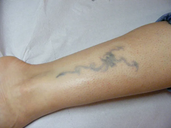 Laser Scar Free Tattoo Removal Session Beauty Salon — Stok fotoğraf