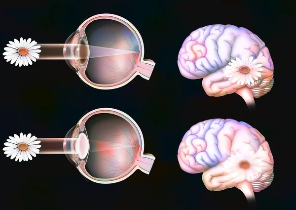 Comparison Normal Vision Eye Cataract — 图库照片