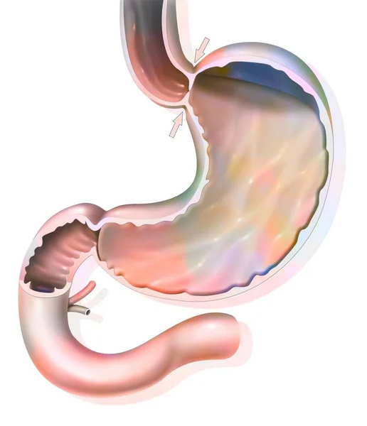 Stomach Normal Hermetic Gastroesophageal Sphincter Preventing Gastroesophageal Reflux — Stockfoto