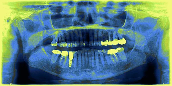 Dental Panoramic Year Old Person Implant Crowns — Stok fotoğraf