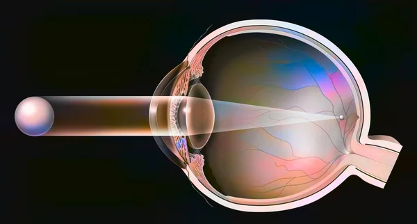 Nearsighted Eye Image Formation Front Retina — Zdjęcie stockowe
