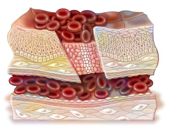 Intermediate Phase Healing Platelets Have Formed Platelet Nail — Fotografia de Stock