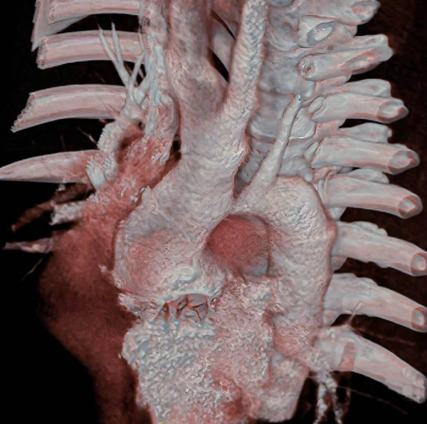 Aortic Coarctation Narrowing Aorta Often Considerable Sometimes Complete Most Commonly Stockbild