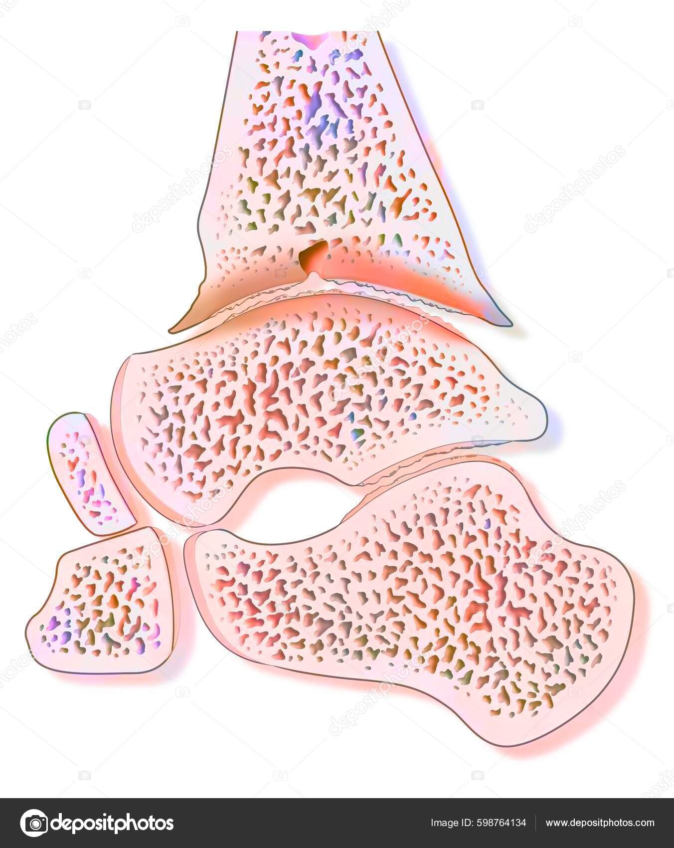 Hemophilic Arthropathy Ankle Hemarthrosis Stock Photo by ©imagepointfr