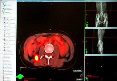 Treatment of an adrenal tumor by radiotherapy in oncology.