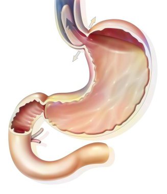 Stomach: gastroesophageal reflux disease in the gastroesophageal sphincter.