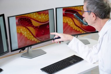 A doctor showing atheroma plaque and stent placement images on computer screens.