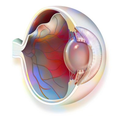 Eye: detachment of the retina, which detaches from the underlying choroid.