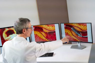 A doctor showing atheroma plaque and stent placement images on computer screens.
