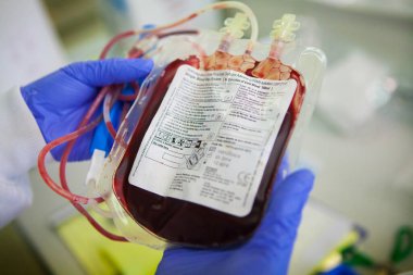 Biobank, bag containing cord blood stem cells (hematopoietic stem cells).