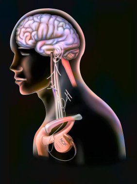 Treatment of epilepsy by stimulation of the vagus nerve with a neurostimulator box.