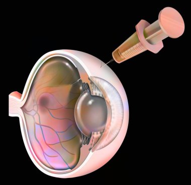 Eye: treatment of macular degeneration by RNA interference.