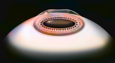 Eye, surgery, photokeractectomy step 2: the eye after the refractive photokeratectomy operation.