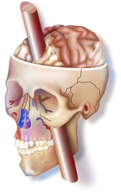 The frontal lobe: impact of the bar in Phineas Gage's skull on his emotions.
