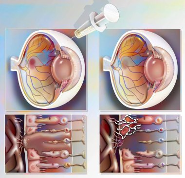 Treatment of macular degeneration by injection of RNA interference. clipart