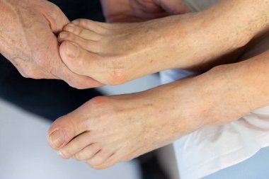 Detail of a woman's foot with a hallux valgus