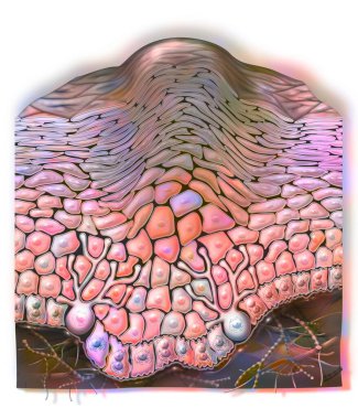 Common wart: benign skin epithelial tumor caused by papillomaviruses.