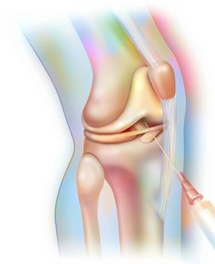 Knee joint, arthrography: injection of contrast product to make structures visible on the radio.