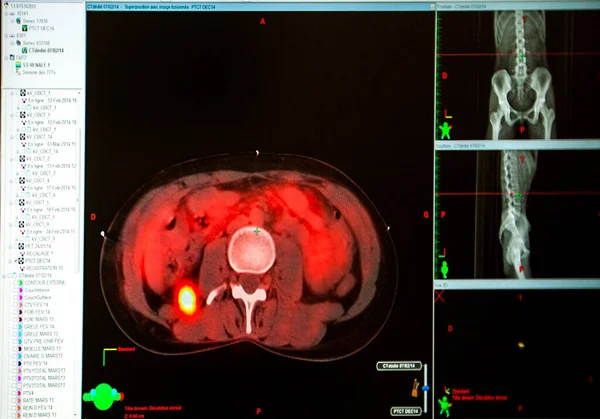 Treatment Adrenal Tumor Radiotherapy Oncology — Stockfoto