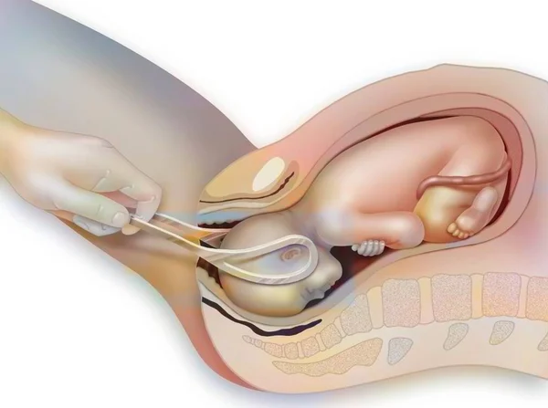 Childbirth Assistance Childbirth Use Forceps — Foto Stock