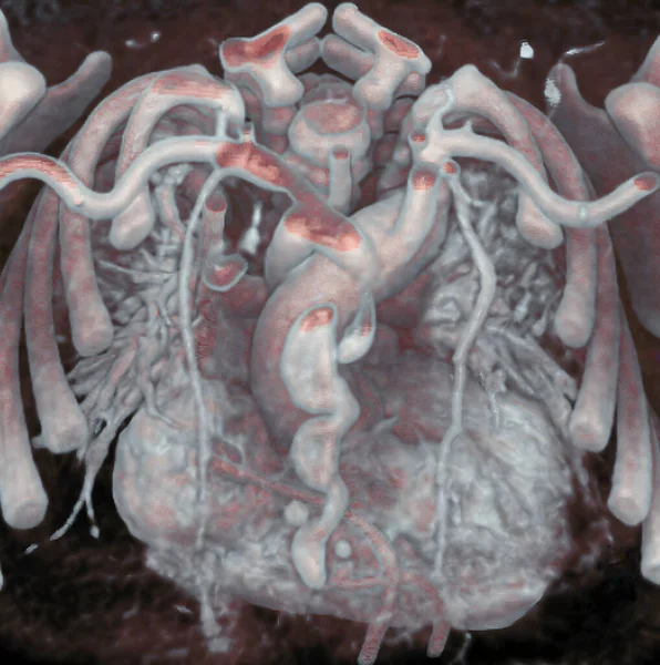 Thorax Newborn Mediastinum Heart Aorta Mammary Arteries Visible Scan — Fotografia de Stock