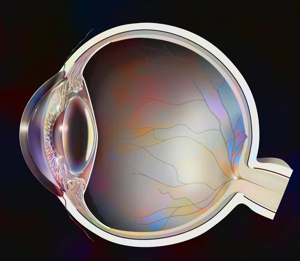 Eye Clouding Lens Case Posterior Subcapsular Cataract — Foto Stock