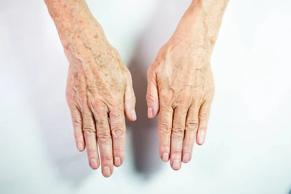 One Hand Spots Old Age Other One Laser Treated — Stockfoto