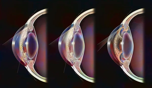 Comparison Normal Eye Open Closed Angle Glaucoma — Photo