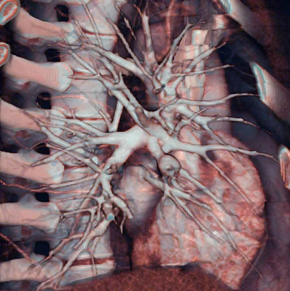 Pulmonary Artery Aneurysm Pulmonary Aneurysm Associated Pulmonary Artery Dilation Risk — Stockfoto