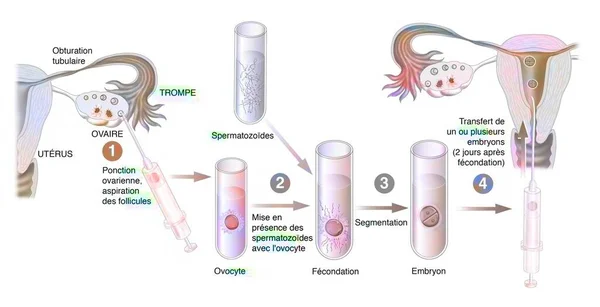 Diagram of the different stages of in vitro fertilization.