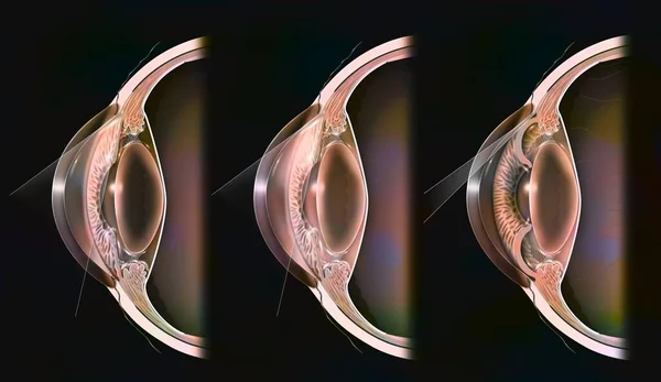Comparison Normal Eye Open Closed Angle Glaucoma — Stockfoto