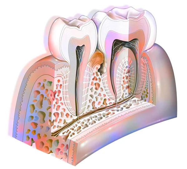 Dental Plaque Main Pathologies Teeth Tartar Gingivitis — Stock Photo, Image