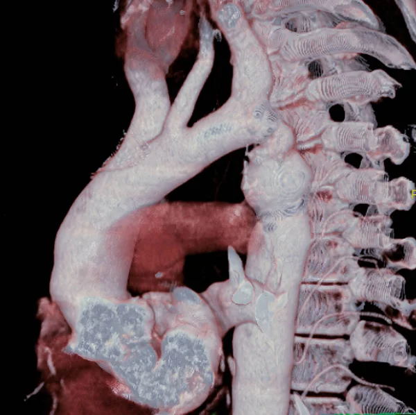 Aortic Coarctation Here Considerable Narrowing Aorta Visible Just Point Aorta — Fotografia de Stock