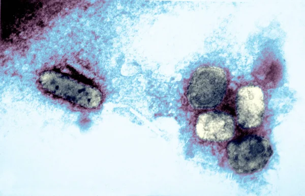 Smallpox Virus Electron Micrograph Depicts Variola Smallpox Virus Using Negative — Zdjęcie stockowe