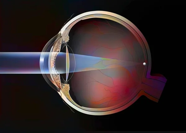 Eye Cataract Intraocular Implants Anterior Posterior Chamber — Stockfoto