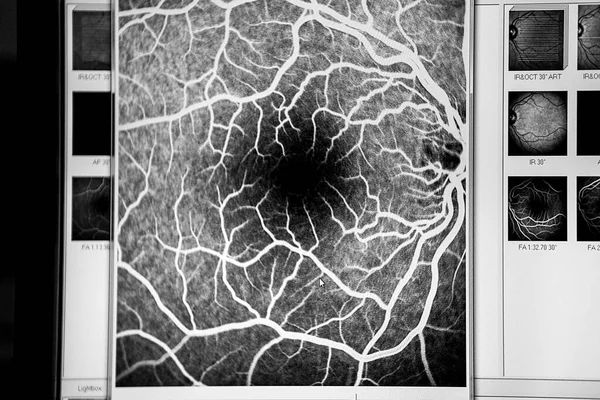 Angiofluorography Patient Risk Glaucoma — ストック写真