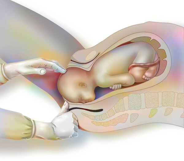 Childbirth, step 1: the baby's head comes to the opening of the vagina.