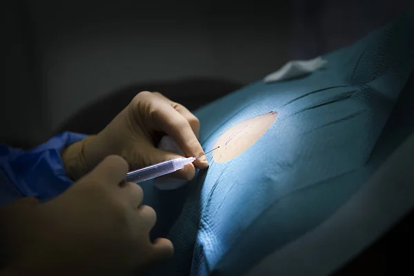 Anesthesia Removal Cyst Dermatology Practice — Fotografia de Stock