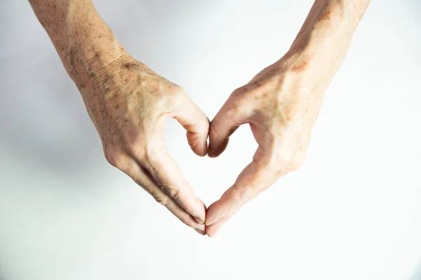 One Hand Spots Old Age Other One Laser Treated — Stockfoto