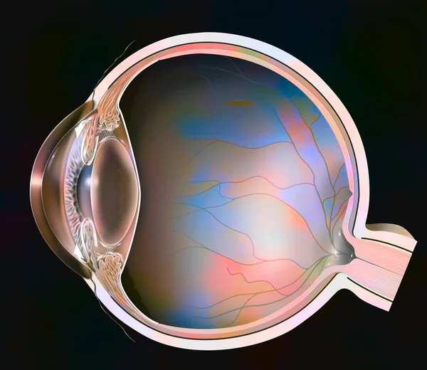 Open Angle Glaucoma Trabeculae Blocked Longer Allow Aqueous Humor Drain — Stock Photo, Image